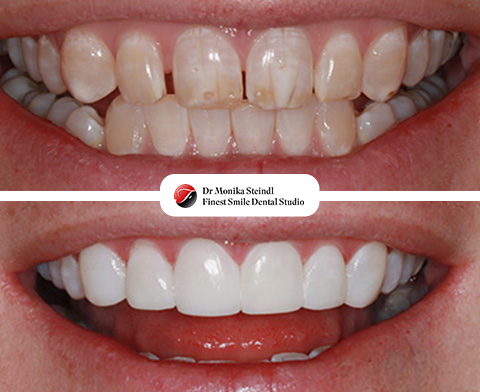 Composite Bonding<br>Bournemouth