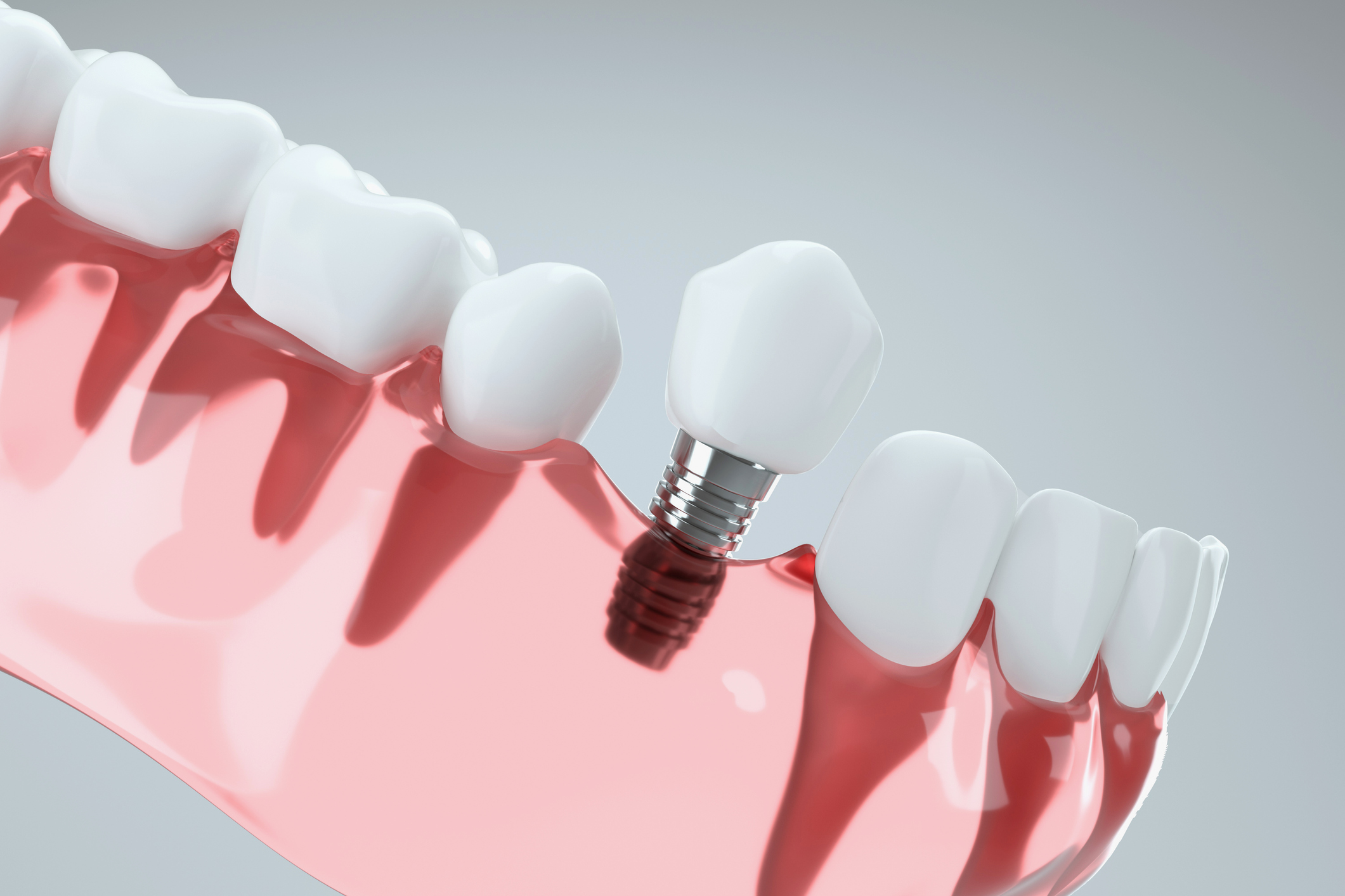 Dental Implants Bournemouth. Photo of a 3d image of tooth implant.