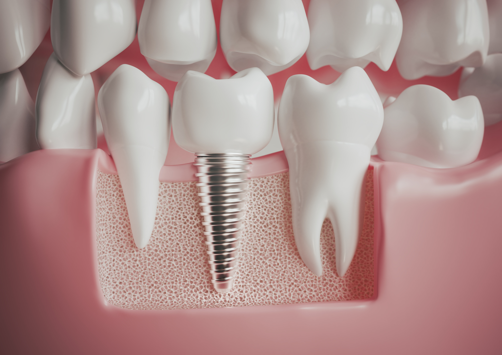 Dental implant