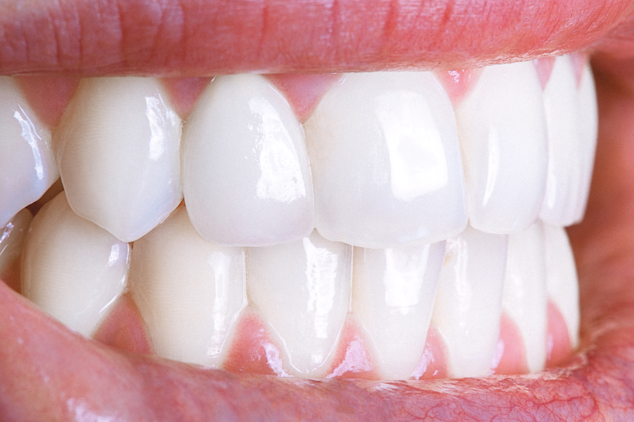 Composite Bonding Bournemouth. Image of a beautifully white smile achieved with composite bonding.