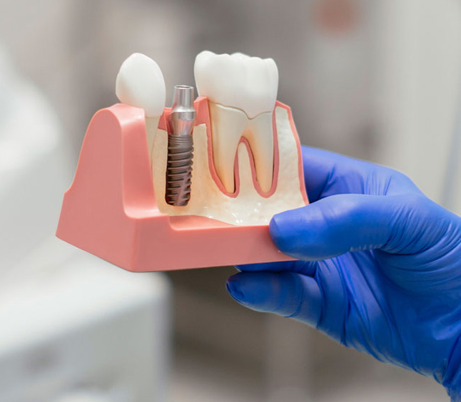 Dental Implants