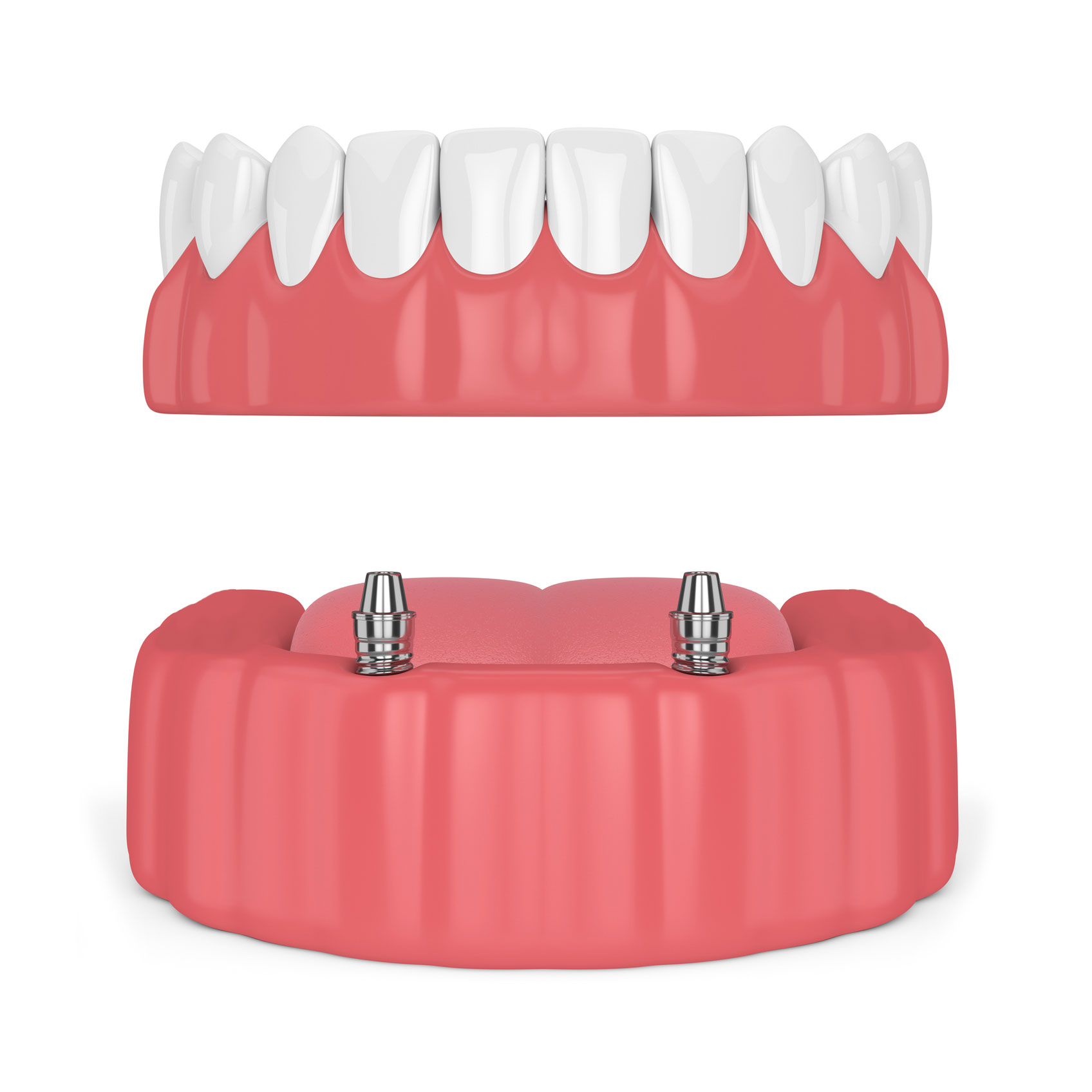 Implant retained denture