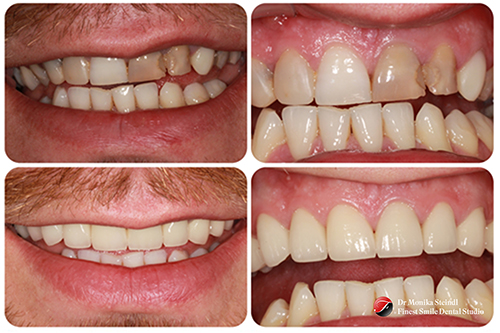 Dental Crowns Bournemouth. Before and after image of dental crowns at Finest Smile dentist Southbourne.