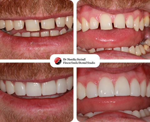 Dental Crowns