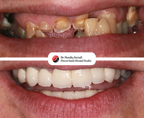 Dental Bridges<br>Bournemouth