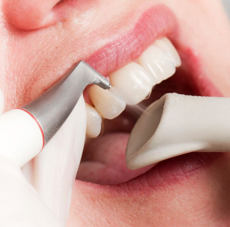 Air Polishing Southbourne. A closeup image of a mouth during the Air Polishing teeth cleaning Bournemouth treatment.