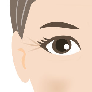 Crows feet