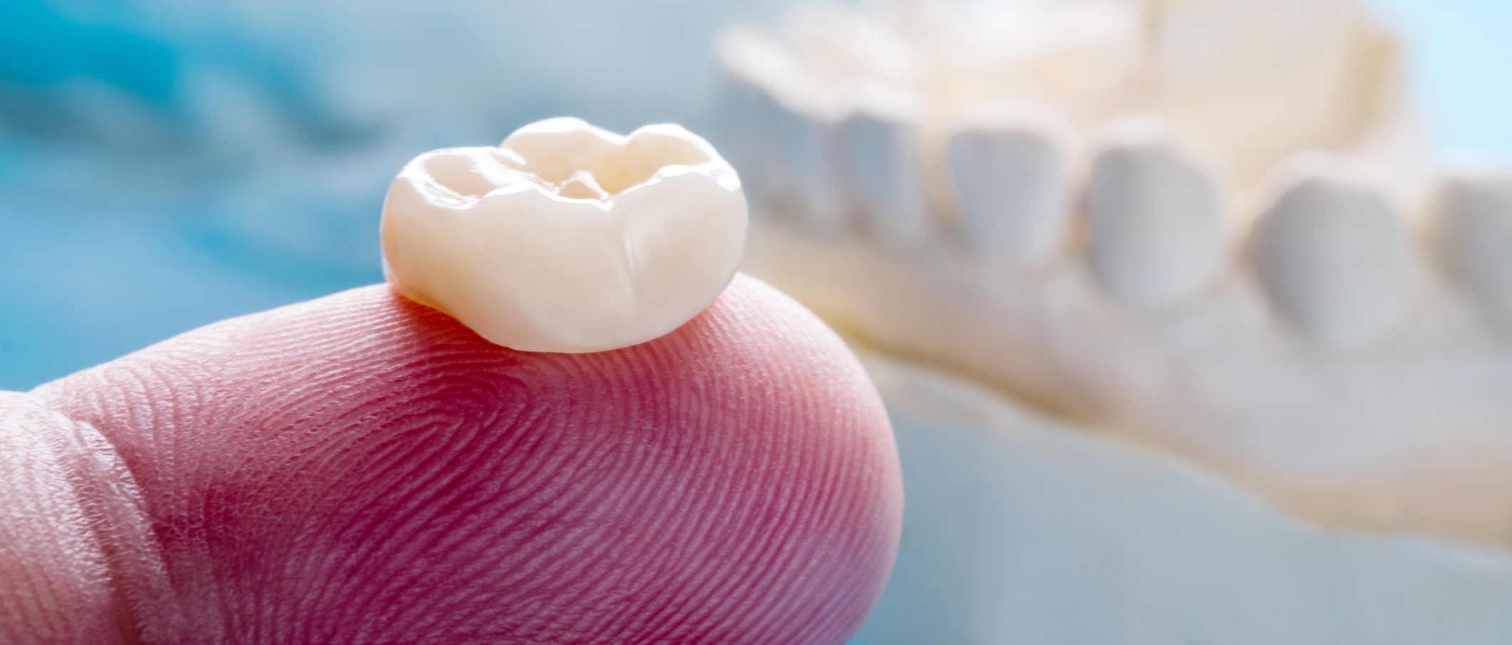 Dental Crowns