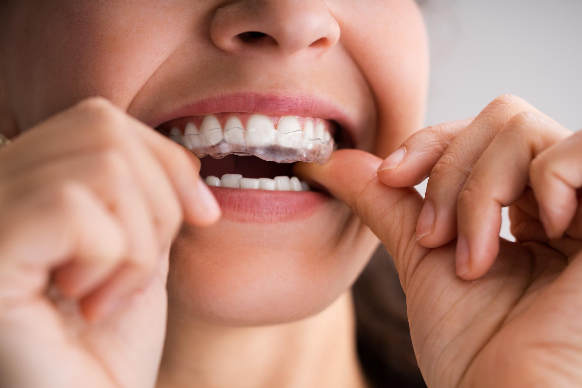 Invisable aligners
