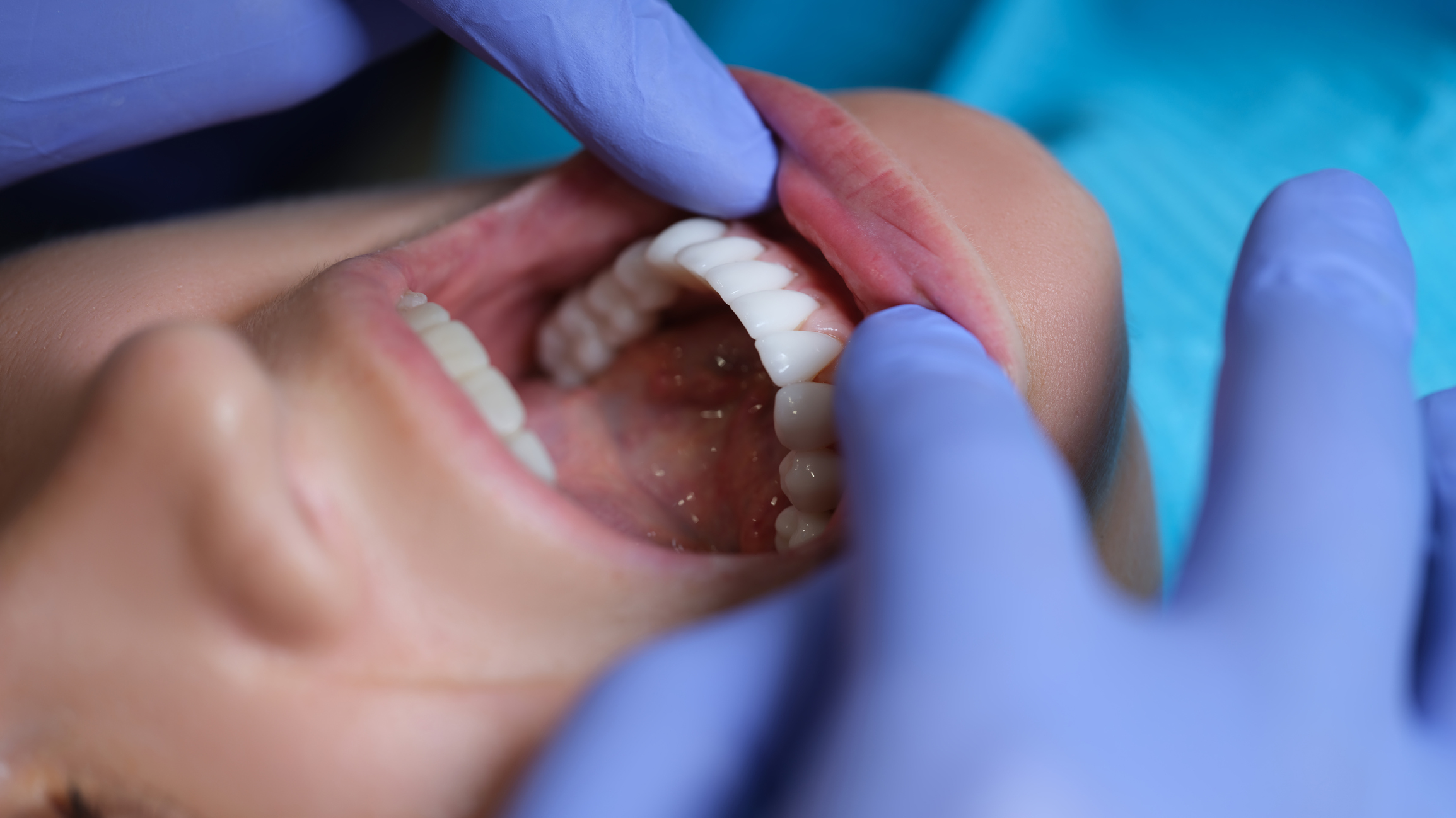 Veneers closeup