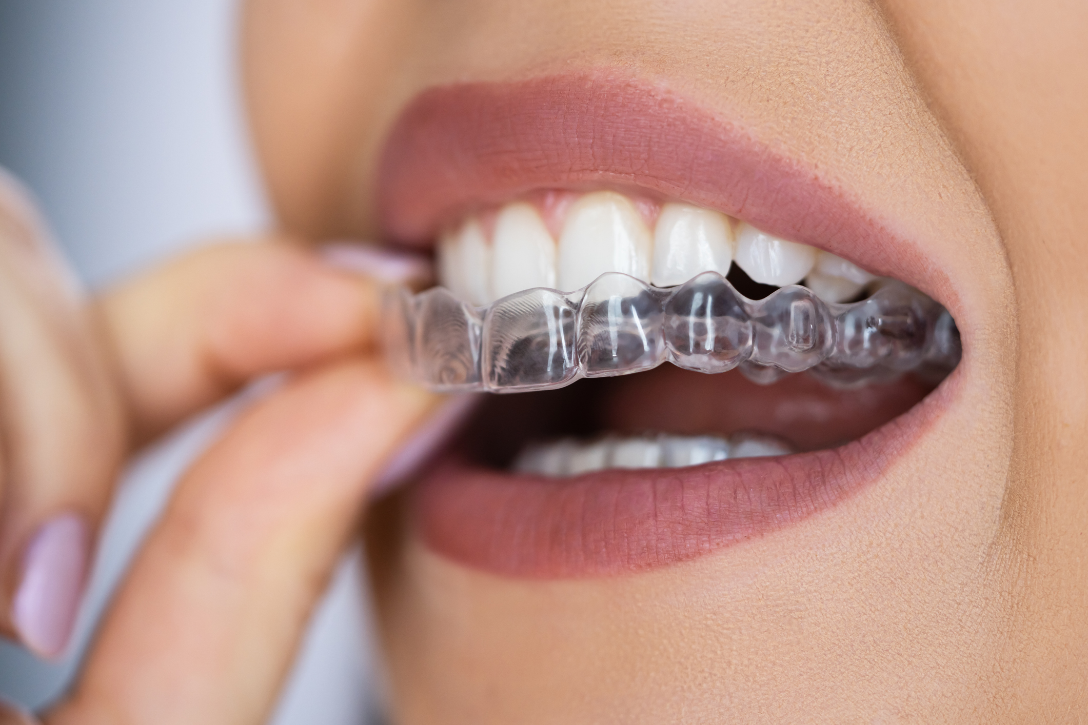 Clear Aligners (Invisalign<sup>&reg;</sup>) clear aligner
