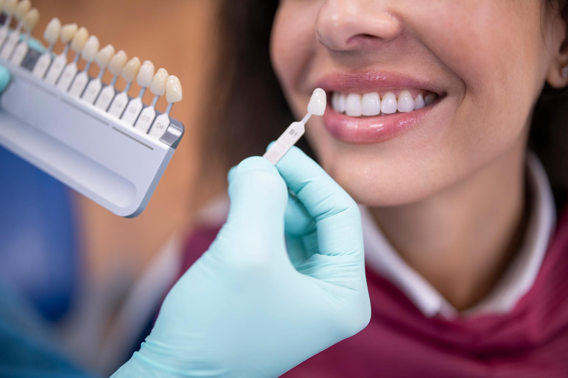 Dental veneers