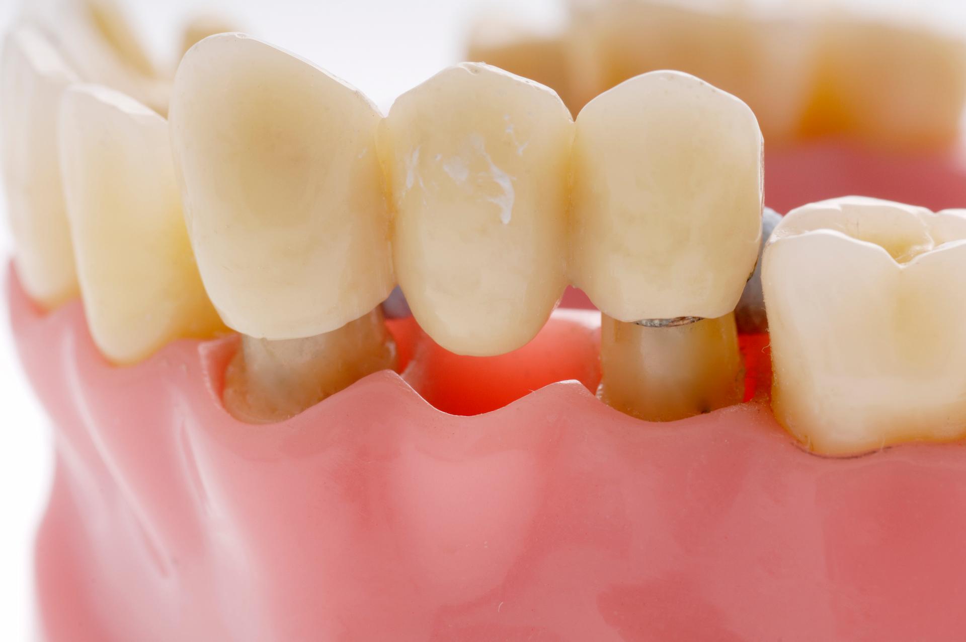 Dental bridges Bournemouth. Closeup image of a dental bridge.
