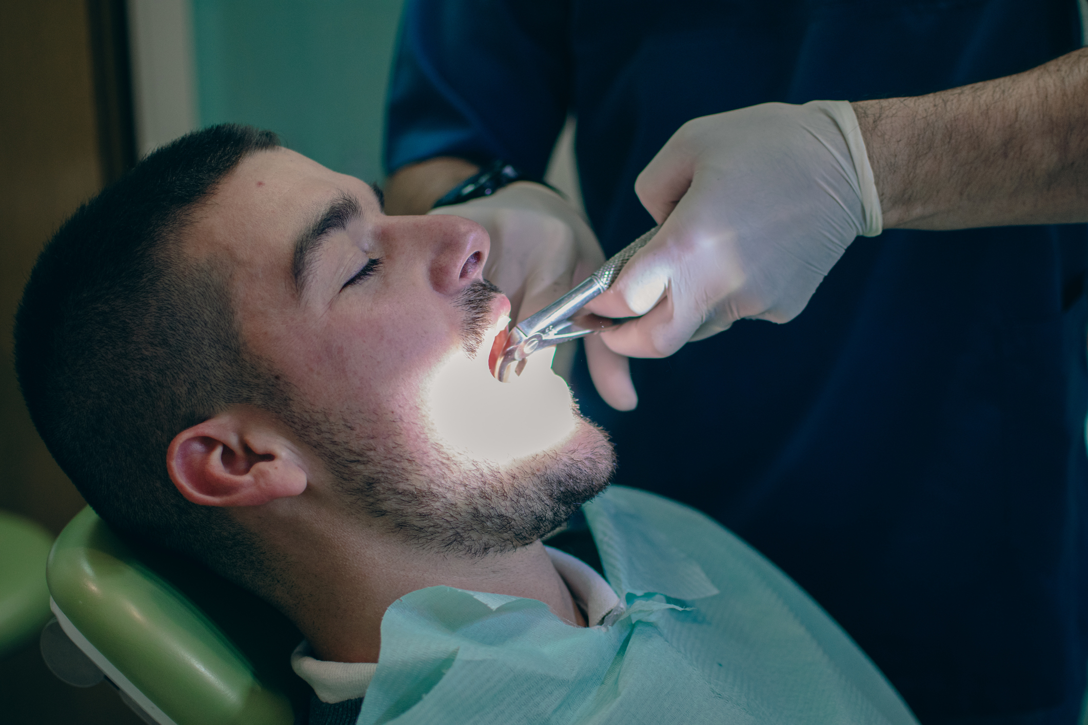 Tooth extraction with forceps