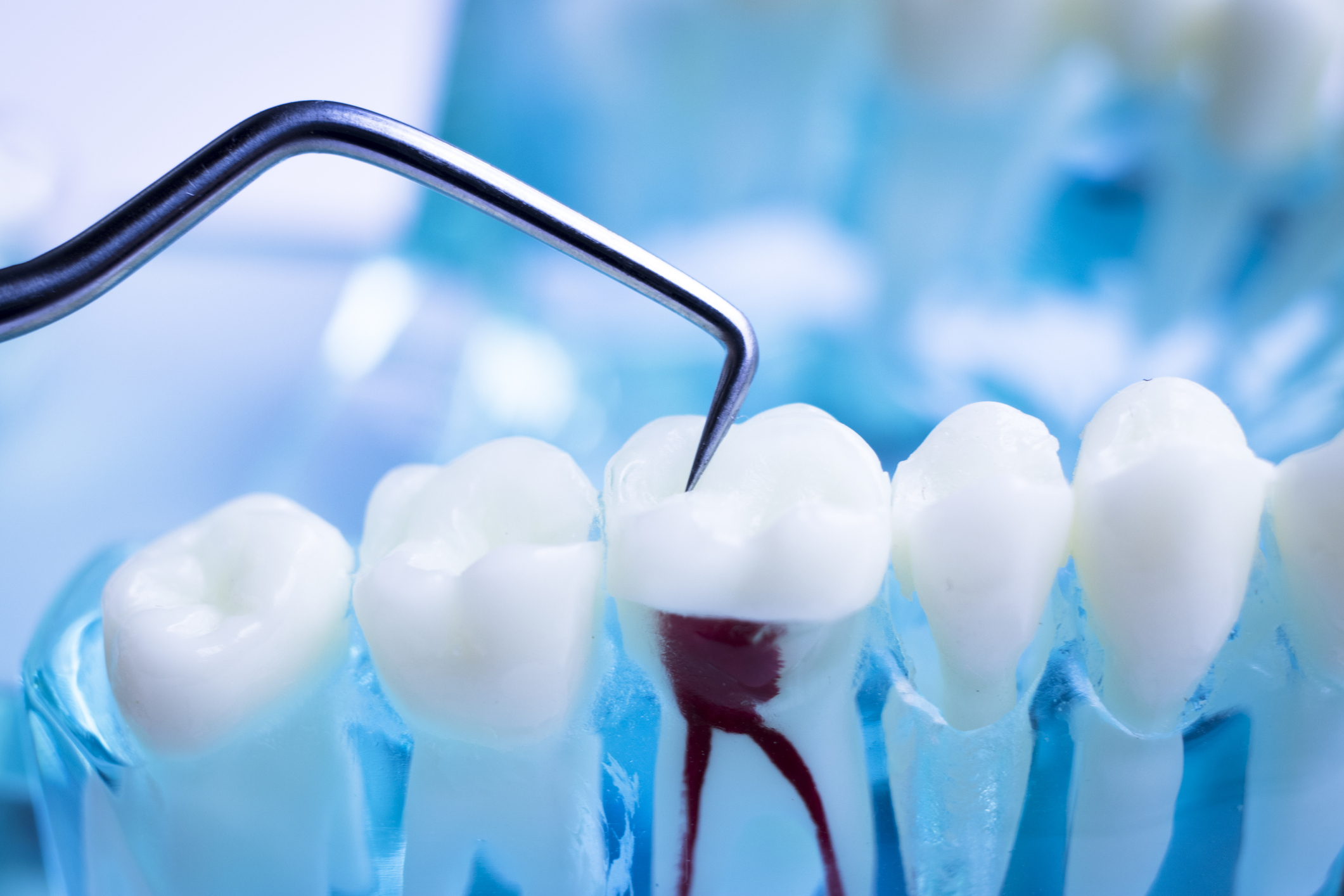 Root canal treatment