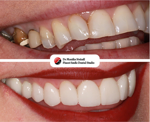 Veneers Southbourne