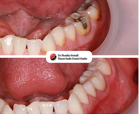 White Fillings