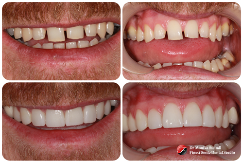 dental veneers in southbourne