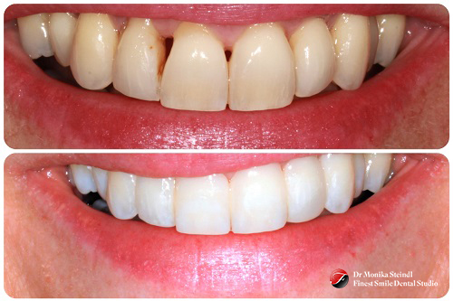 Composite Bonding