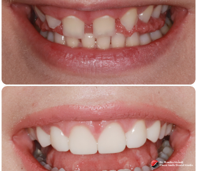 Crowns & Veneers