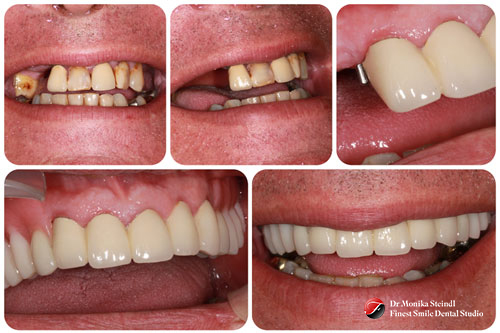 Dentures with Special Attachments