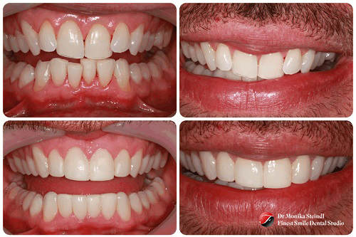 Short Term Fixed Braces
