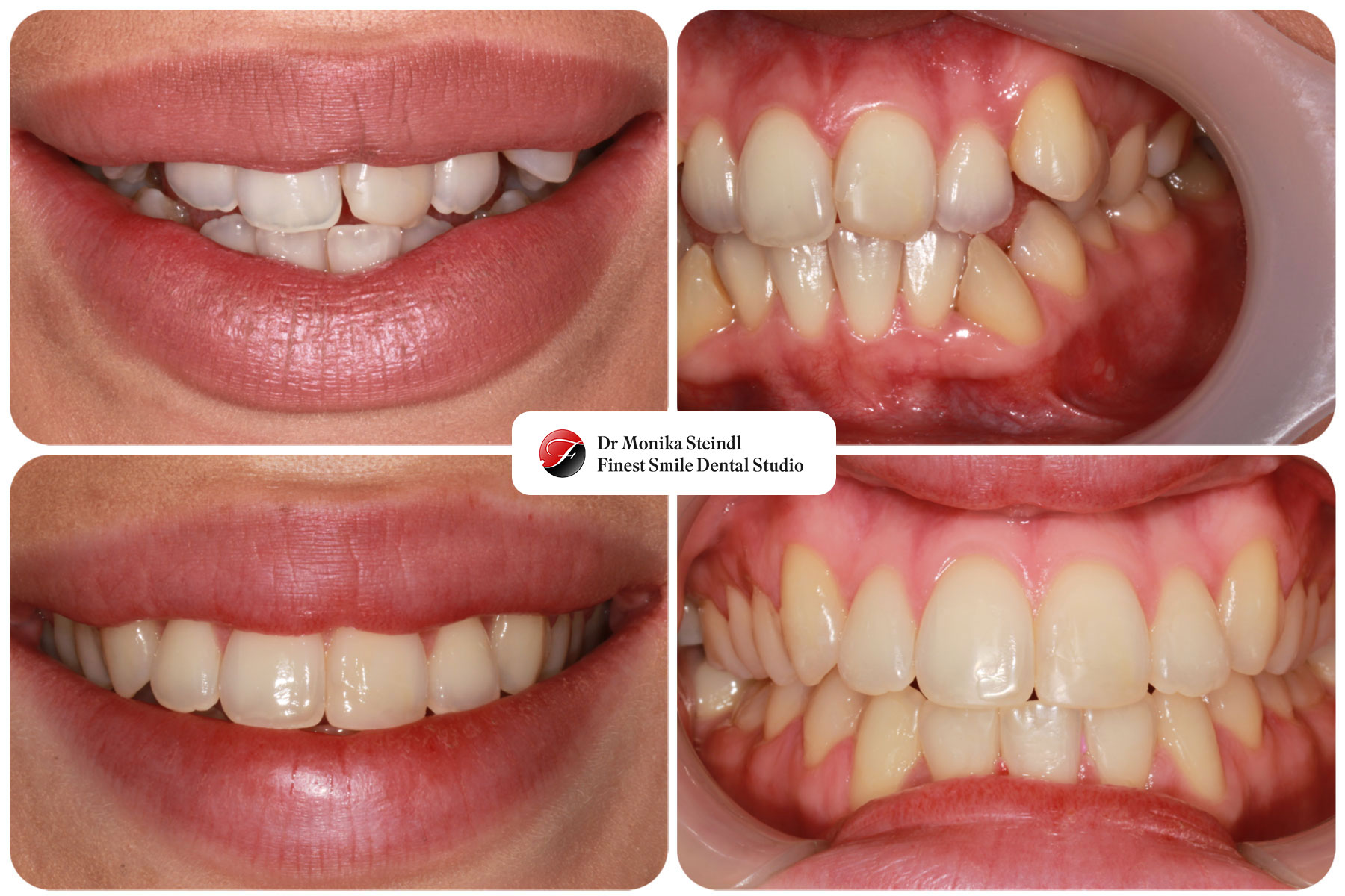 Short-Term Fixed Braces