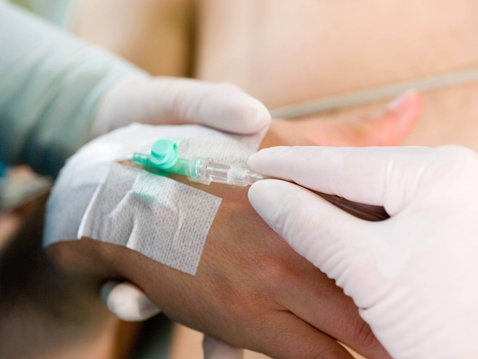 Cannula in back of hand