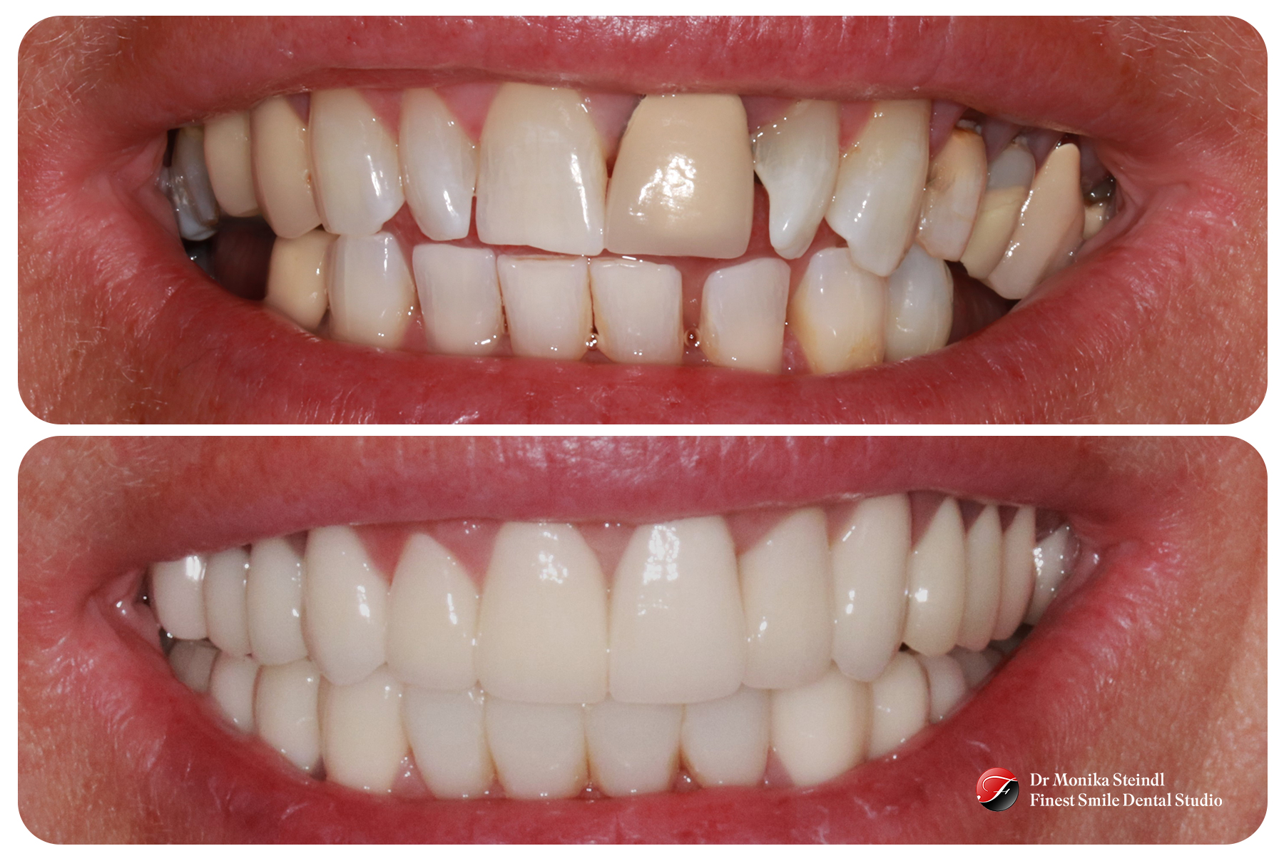 Smile Makeover